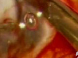 Combined Vitrectomy & Keratoplasty for Complex Cases