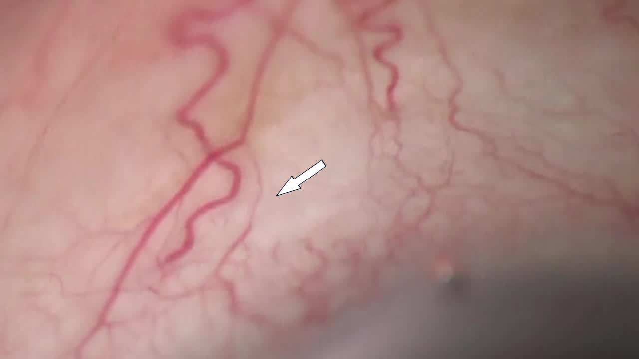 iStent inject Flow and Blanching