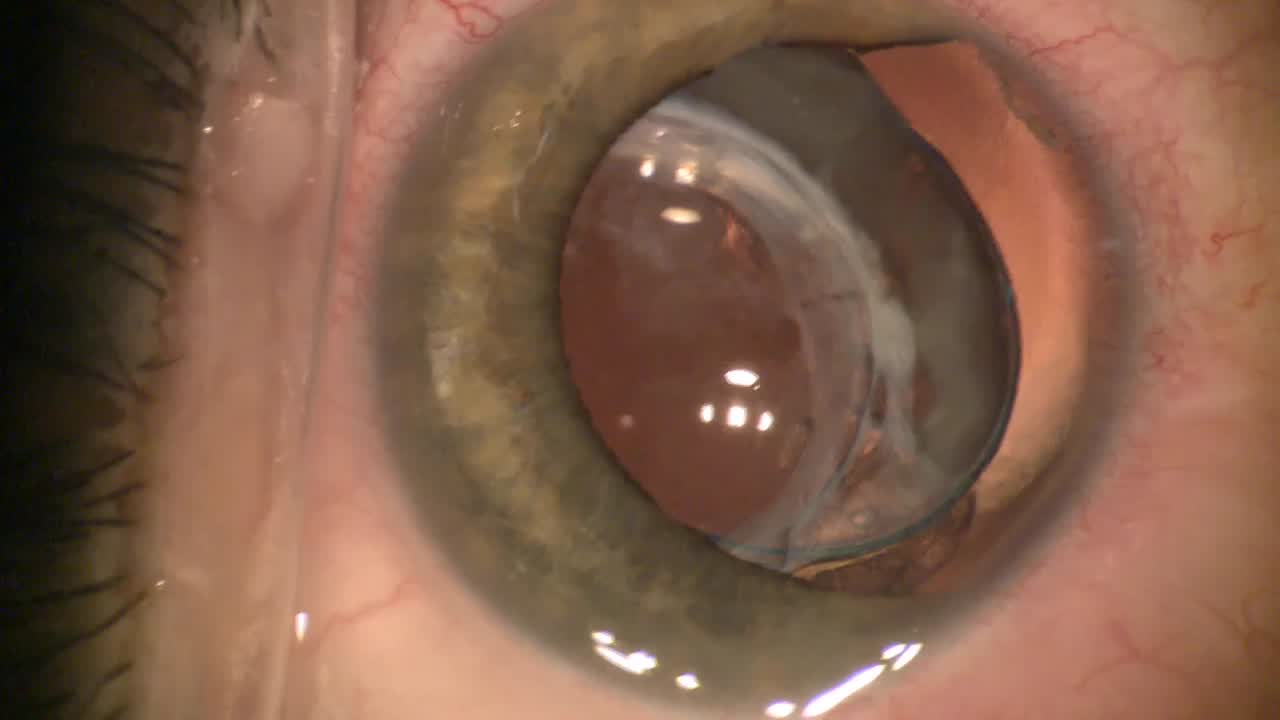 Pupilloplasty s/p Firework Injury, Iris Transection