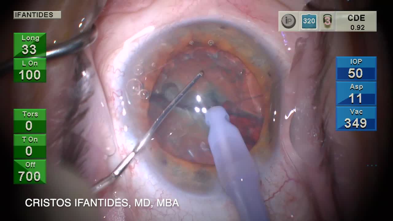 Rotary Chop: A New Technique for Tackling Mature Cataracts and Teaching Chop