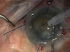 Cataract Surgery in Eyes with Pseudoexfoliation Syndrome