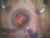 Microincisional Surgery with Softec HD IOL