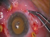 Intrascleral IOL Fixation for Traumatic Lens Subluxation