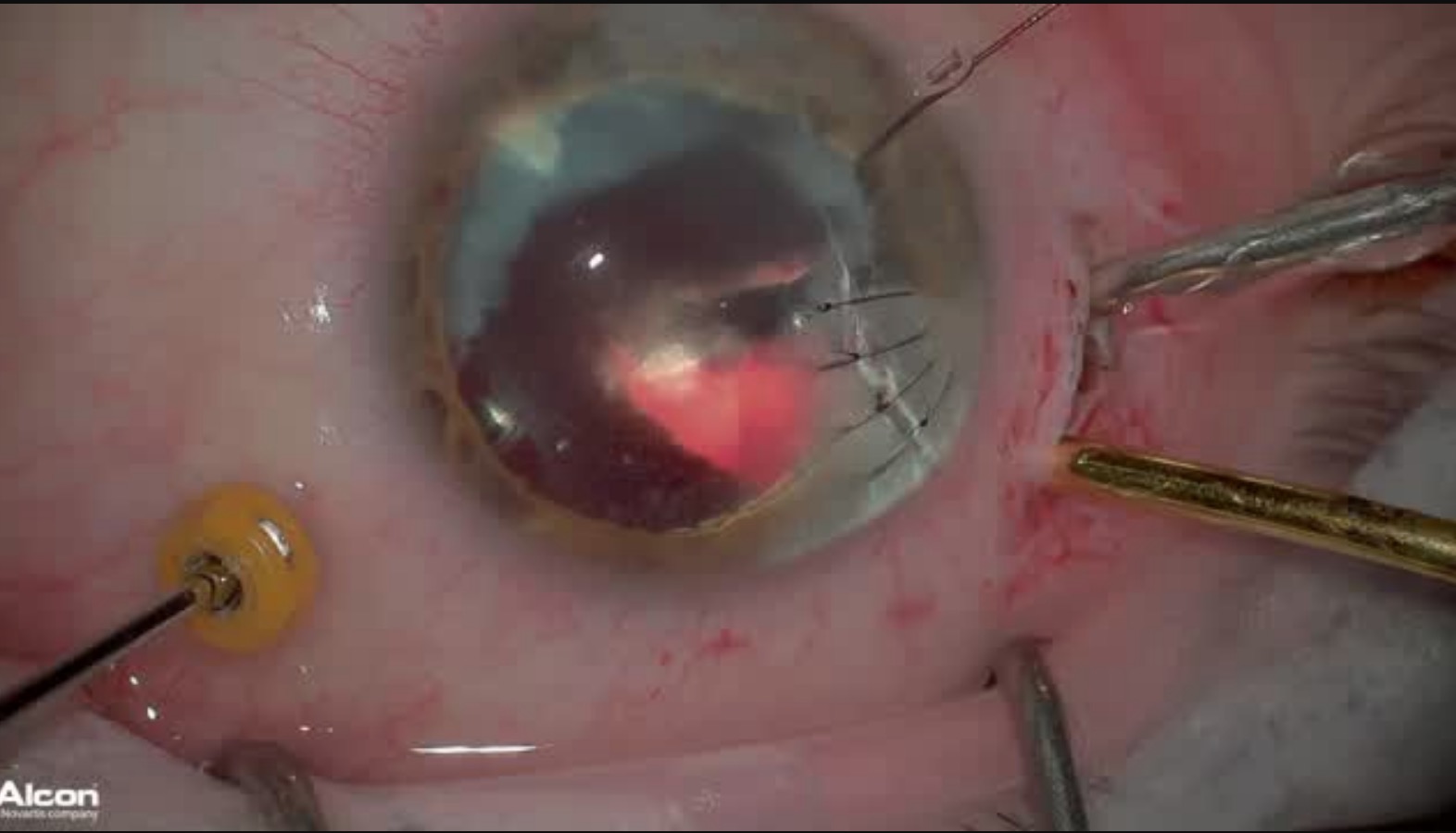 Removal of IOFB in 3-D