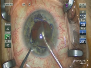 Iris Expansion Devices for Intraocular Surgery