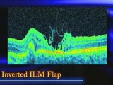 Unusual Traction of the Macula