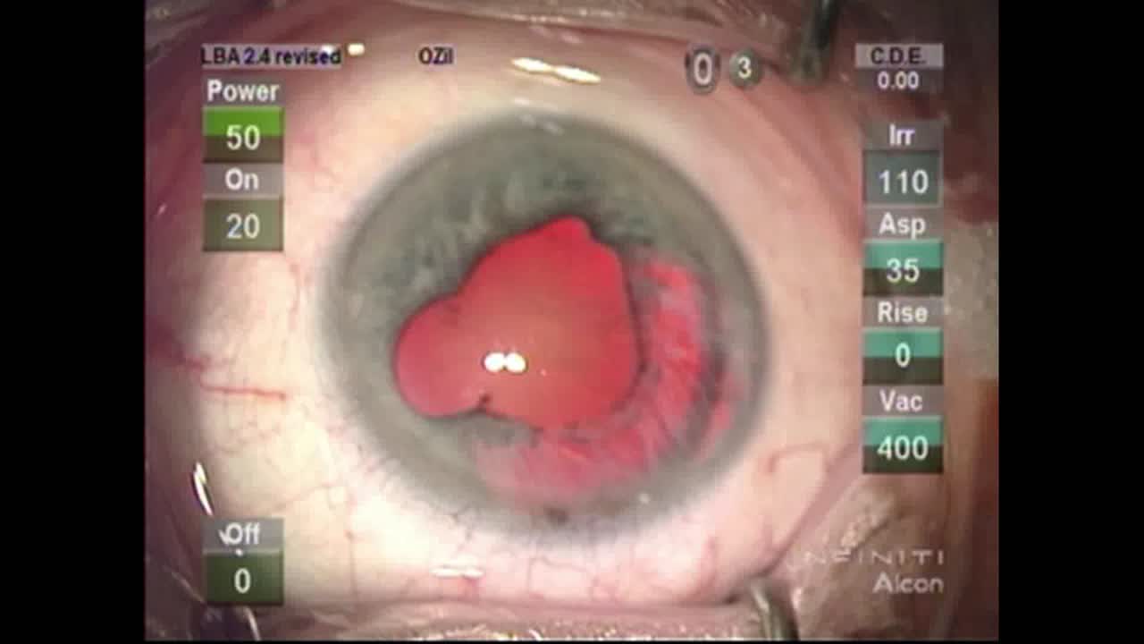 Cataract Surgery Twice