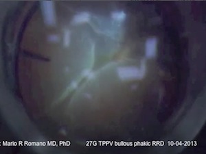 27-gauge Vitrectomy for Rhegmatogenous Retinal Detachments