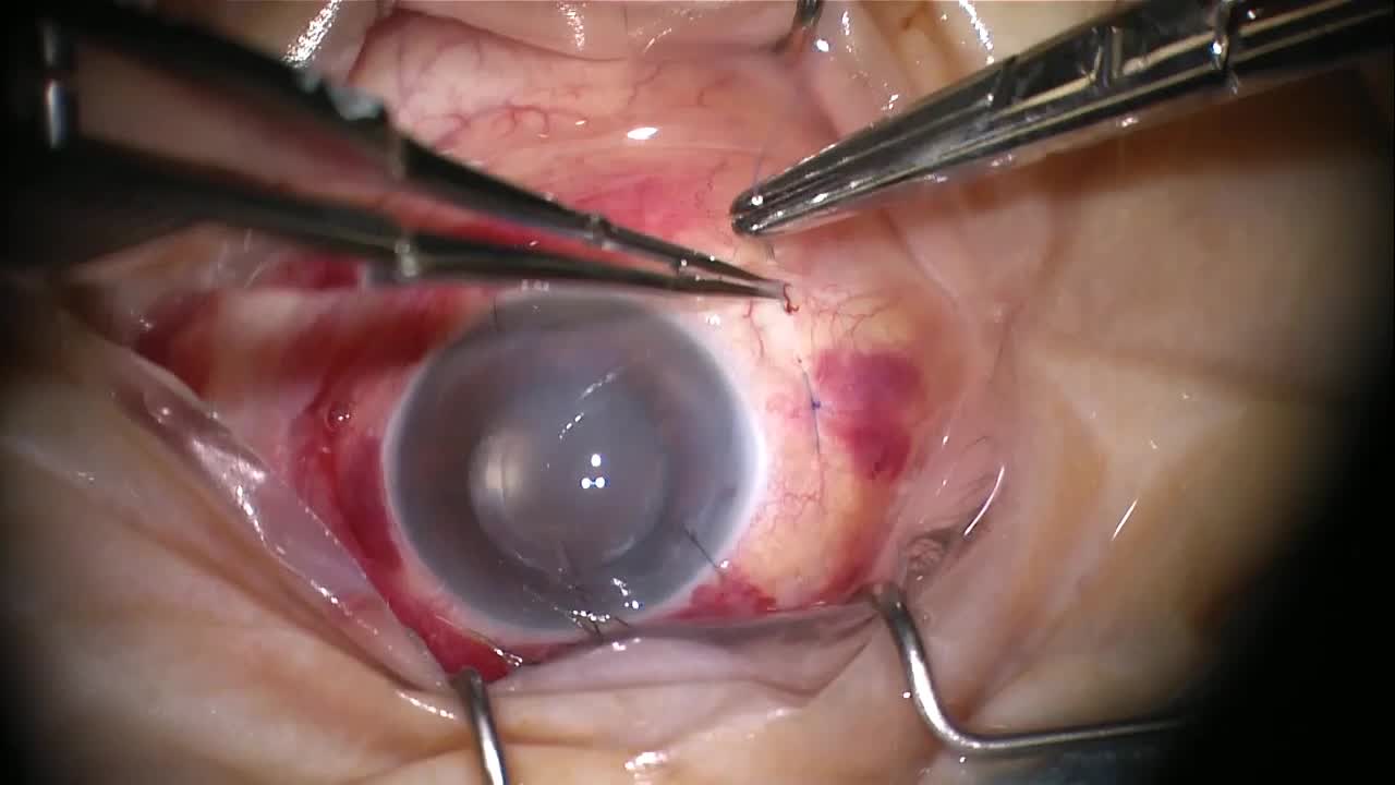 Technique Overview for Surgical Management of Endophthalmitis