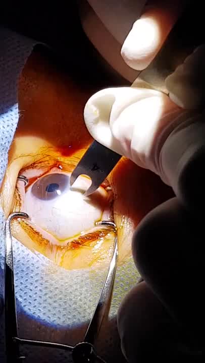 Suprachoroidal Space (SCS ) Injection Technique