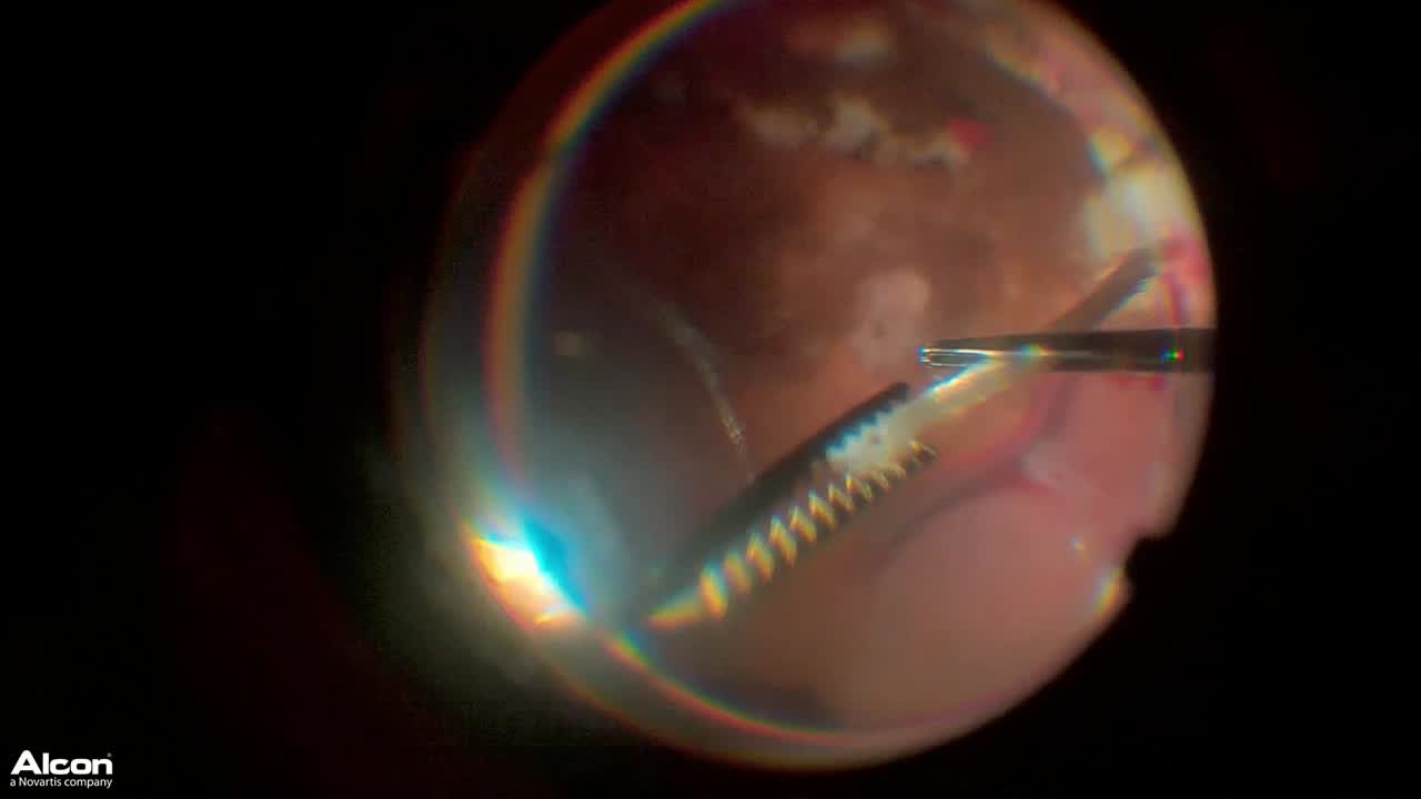Scleral Buckle