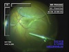 Wrinkles After Vitrectomy