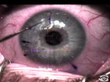 Recurrent Epithelial Ingrowth