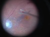 27-Gauge Macular Hole Surgery