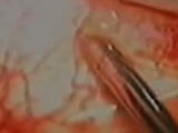 Phaco Passion