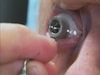 Tecnis Toric Lens Marking