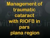 Traumatic Cataract with RIOFB
