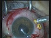 Pars Plana Approach for the Insertion of an Anterior Chamber Artisan IOL