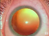 ICL Implantation Technique