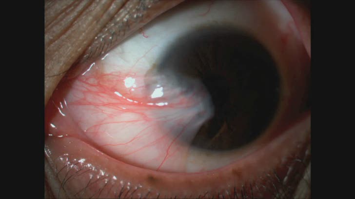 New Technique of Bulbar Flap Conjunctival Pedicle