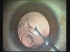 Angle Kappa in Multifocal IOL