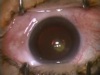 Posterior Polar Cataract - Part 1