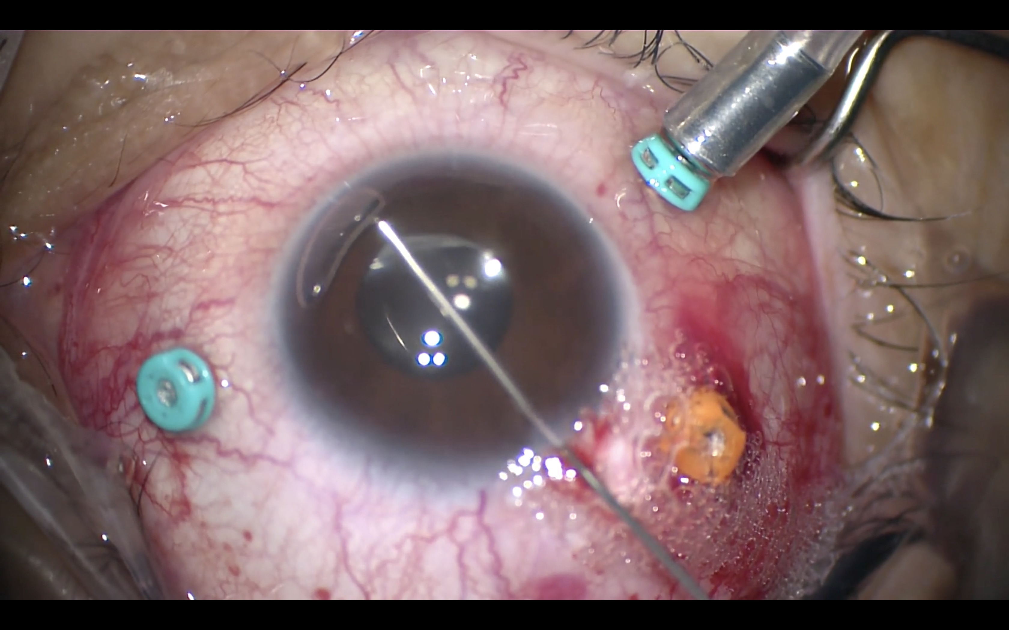 Macula-off Retinal Detachment After Cataract Surgery