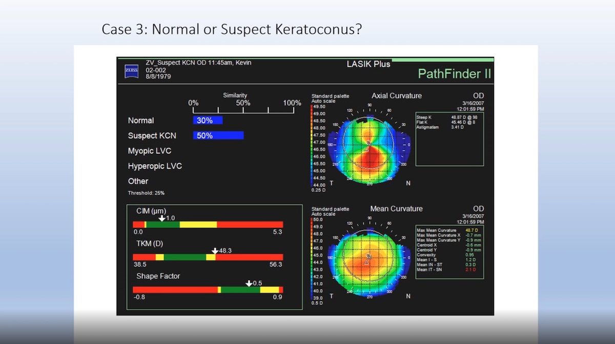 Lasik-to-SMILE Journey Part 2