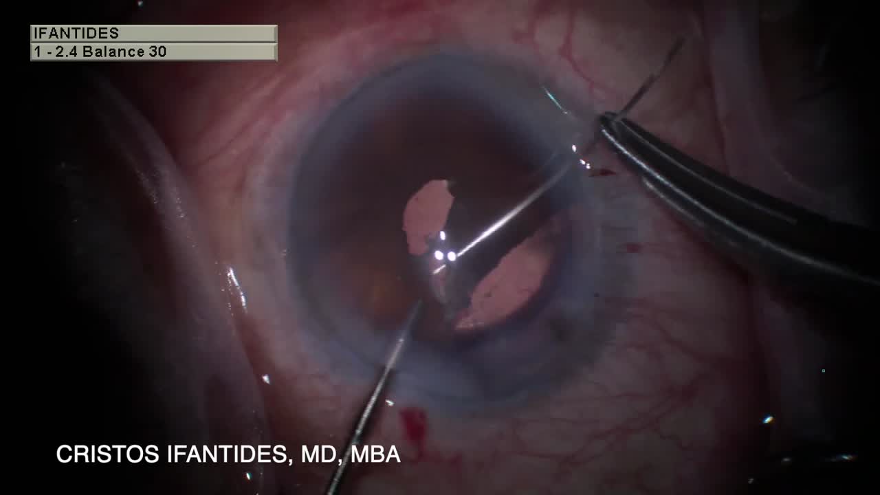 Combined Iris Defect and Iridodialysis Repair