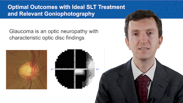 Treating Glaucoma with SLT