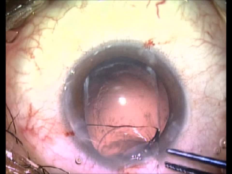 Multifocal IOL Exchange 