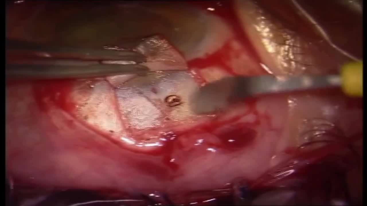 AB Externo 360-Degree Trabecular Meshwork Rip