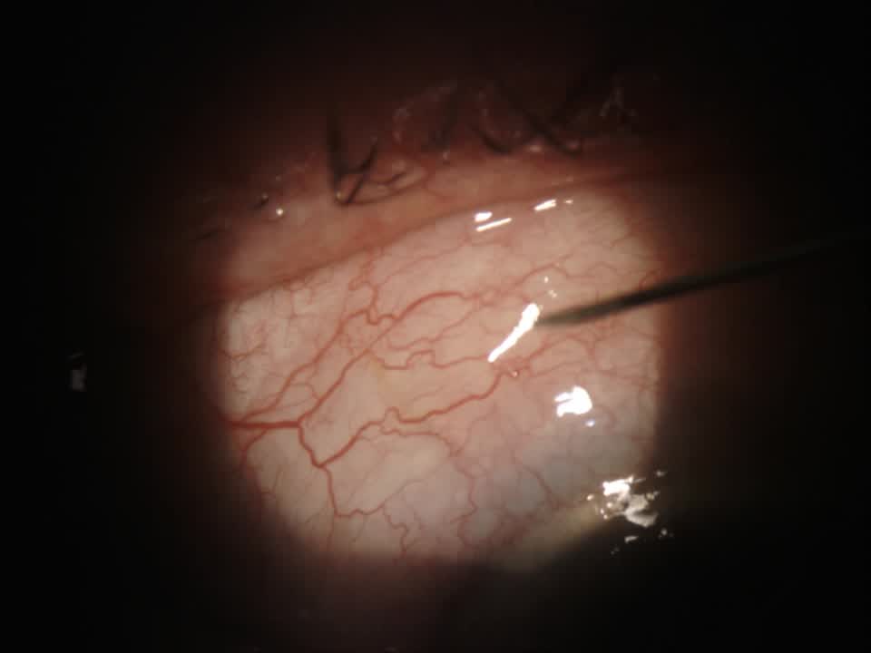 Slit Lamp XEN Needling