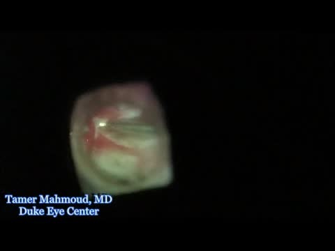 Diabetic Tractional Retinal Detachment 