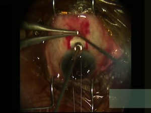 Injection of Mitomycin C Intraoperatively During Trabeculectomy