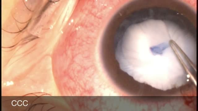 Blunt Ocular Trauma in Child