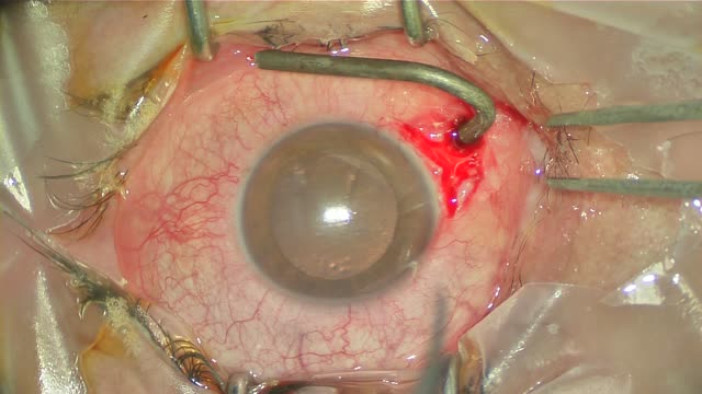 Removal of an Intraocular Foreign Body Case
