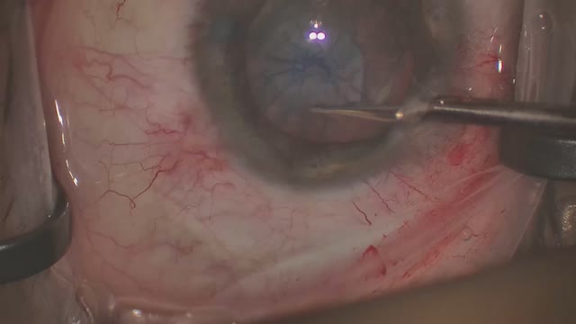 Scissor Capsulotomy