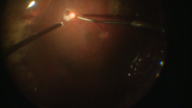 Scleral Buckle and Vitrectomy
