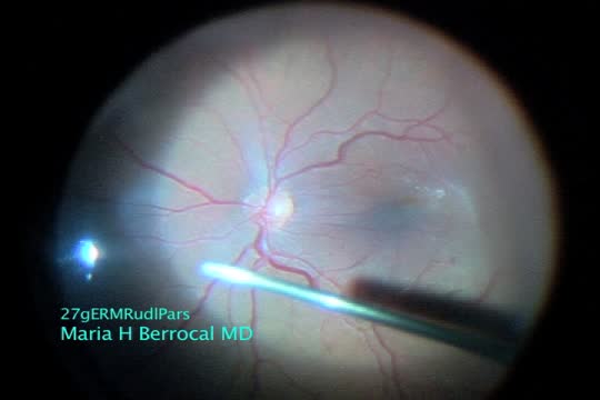 27-Gauge Vitrectomy in an Eye with ERM