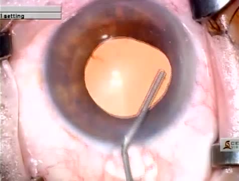 Updated Malyugin Ring® Injector