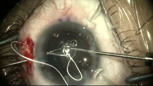 Microspheropakia Cataract Surgery