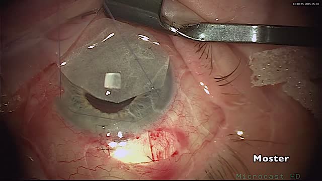 Fornix Based Trabeculectomy with MMC