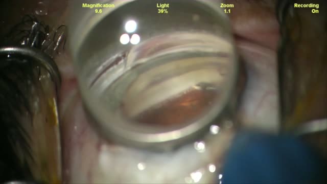 Hydrus Microstent