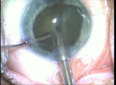 Small Pupil Comes Down