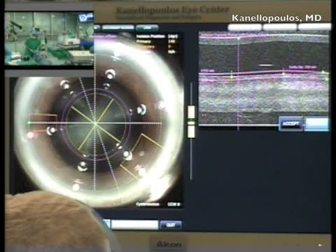 Crystalens HD Implantation in Post LASIK
