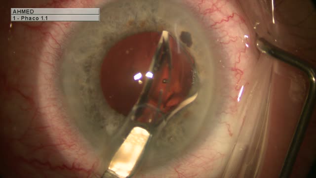 IOL Exchange and Double Optic Capture for the Management of Uveitis-Glaucoma-Hyphema Syndrome