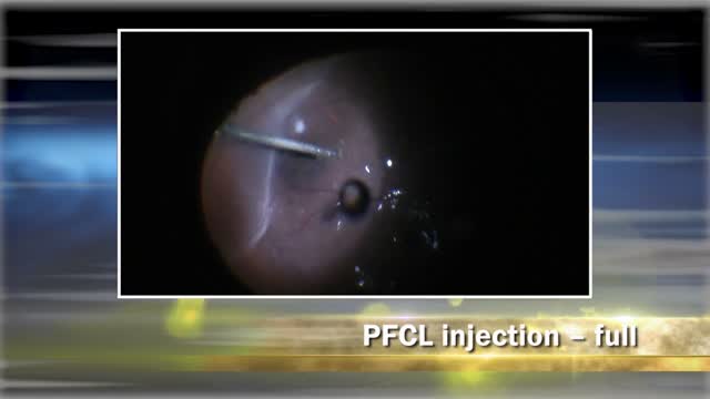 Pars Plana Vitrectomy for Rhegmatogenous Retinal Detachment: From A to Z