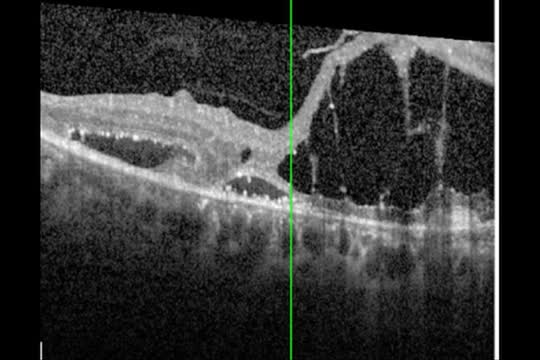 27-Gauge Instruments for Retinal Detachment