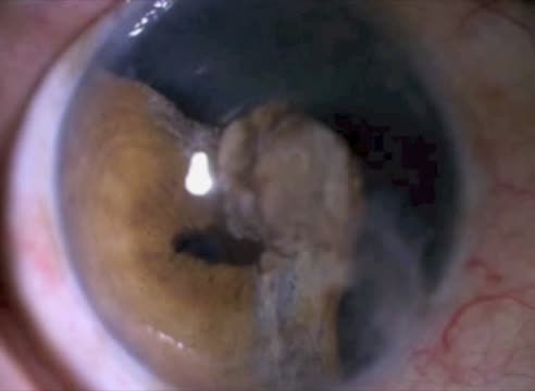 Managemant Of Late Term Iridodialisis And Traumatic Cataract Due To Penetrating Injury; Iridopexy, Pupilloplasty And Lensectomy